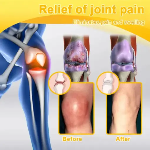 ADNOON™ Botulinum Toxin & Bee Venom Pain-Relief Bone Healing Cream