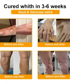 ADNOON™ Botulinum Toxin & Bee Venom Pain-Relief Bone Healing Cream