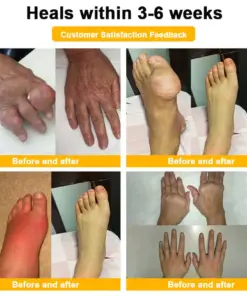 ADNOON™ Botulinum Toxin & Bee Venom Pain-Relief Bone Healing Cream