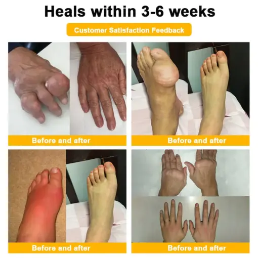 ADNOON™ Botulinum Toxin & Bee Venom Pain-Relief Bone Healing Cream